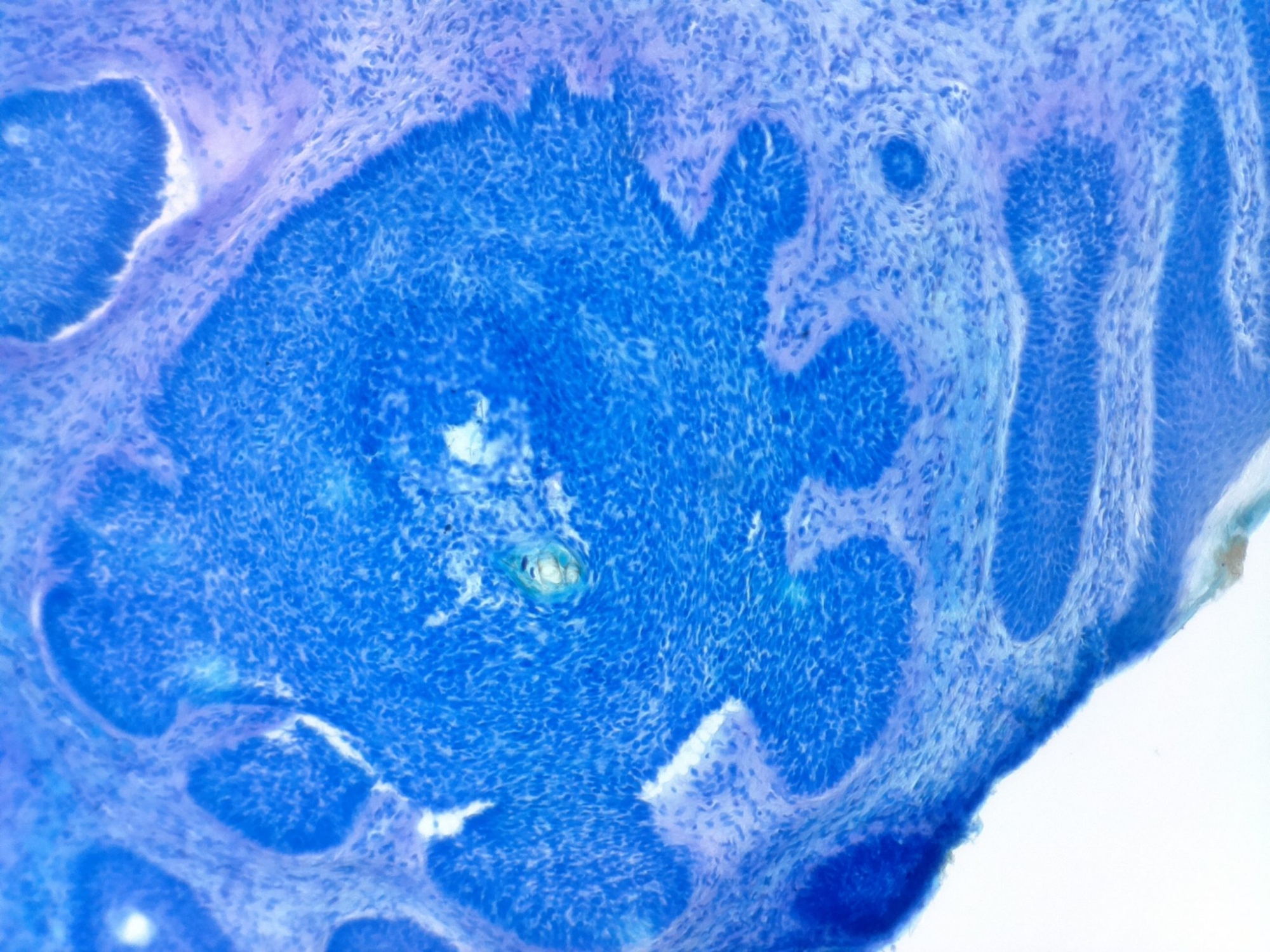 Basal Cell Carcinoma imaged by ioLight The Pathologist August/September 2016